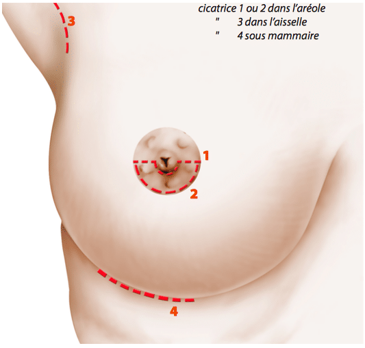 Augmentation mammaire