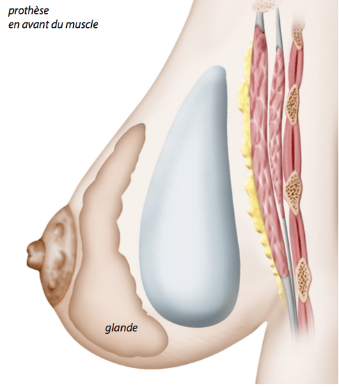Augmentation mammaire 