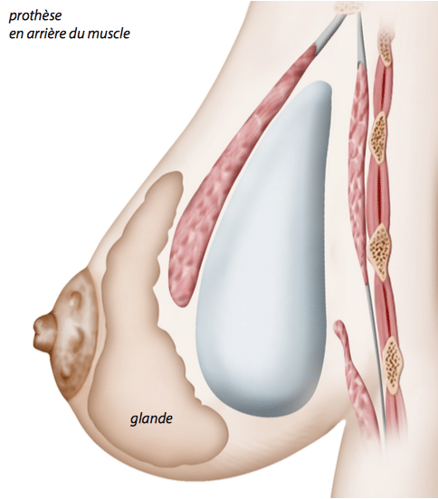 Augmentation mammaire